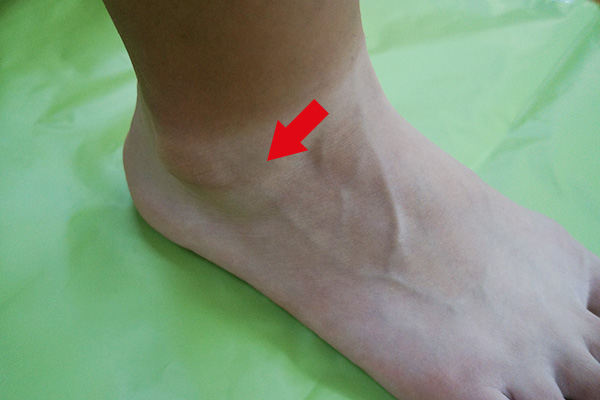 足関節の靭帯損傷の事例